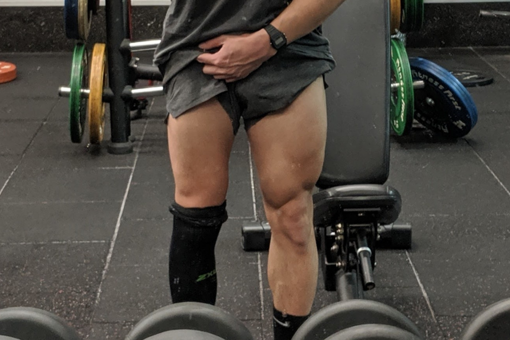 Week 6 post Knee Surgery: muscular atrophy and quadriceps weakness