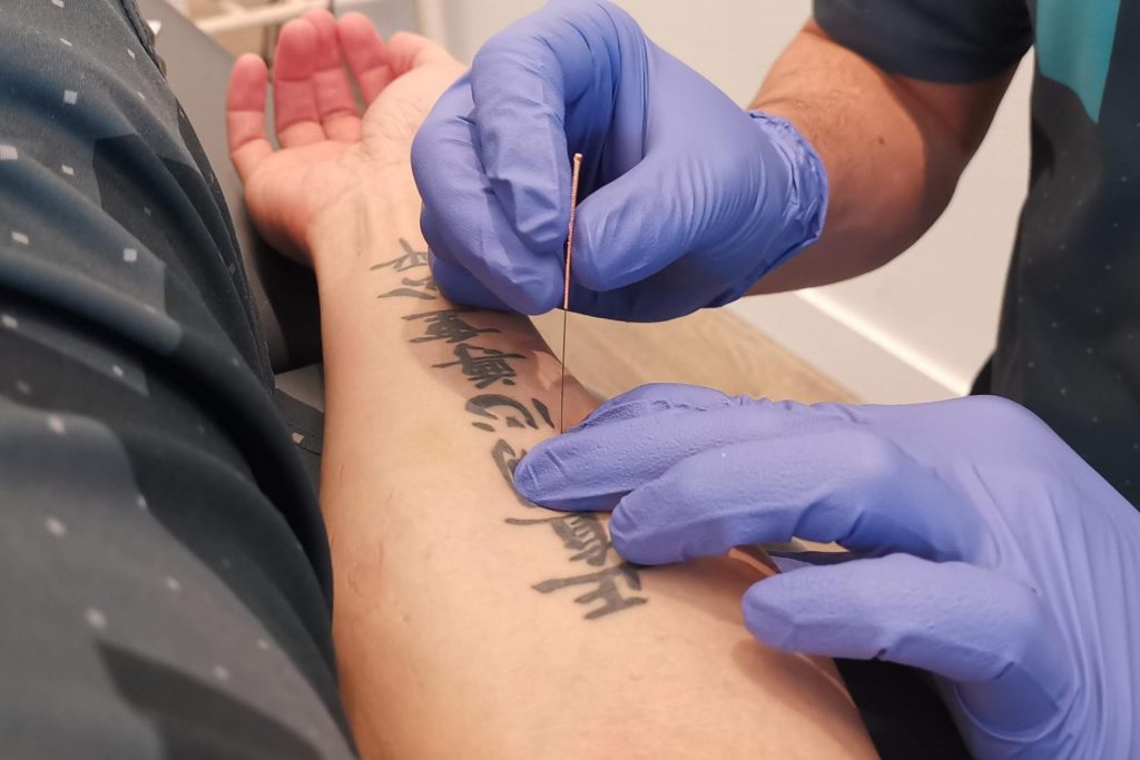 Dry Needling to treat tennis elbow pain