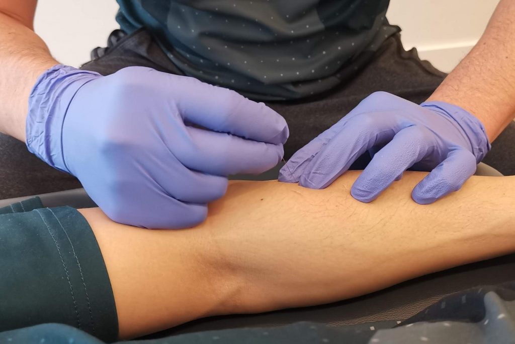 Vancouver Physiotherapist performing IMS dry needling to treat tennis elbow pain.