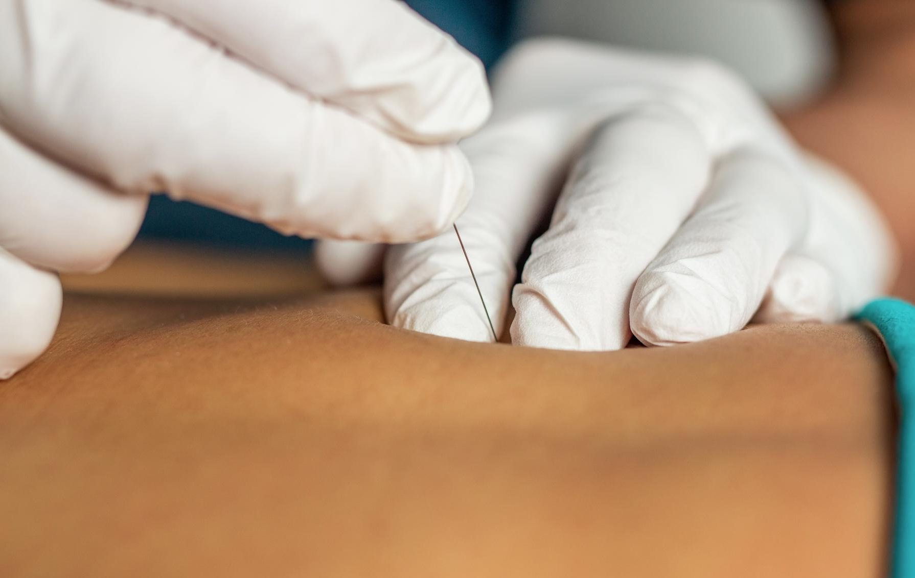 IMS Dry Needling With Your Vancouver Physiotherapist Everything You