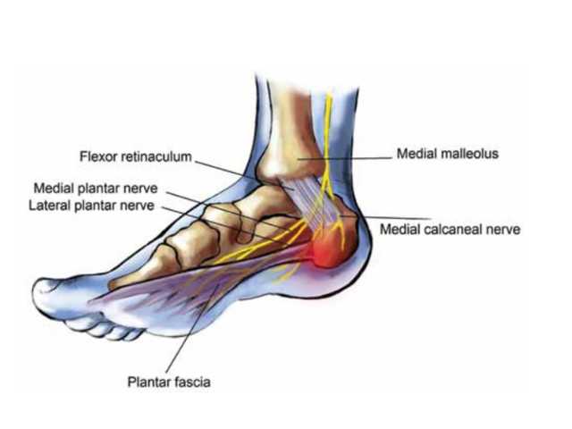 Medial Calcaneal Nerve Irritation